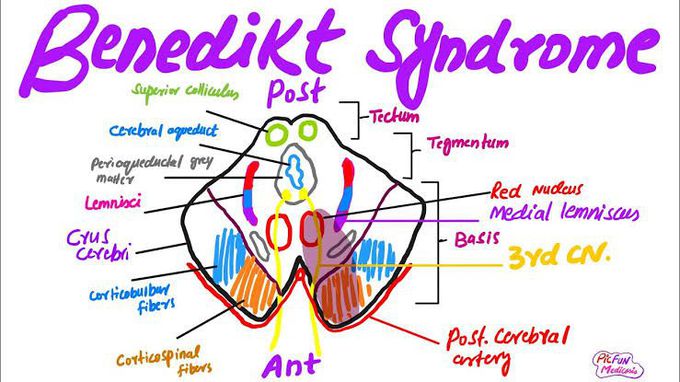 Benedikt syndrome