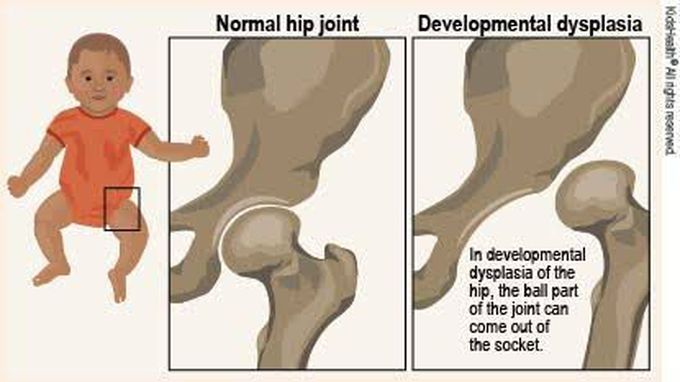 Developmental Dysplasia of Knee