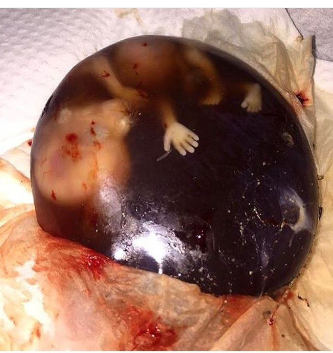 Primature baby