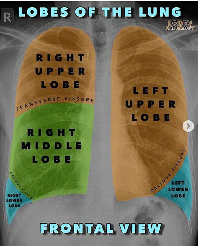 CXR notes in children