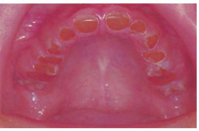 Dentinogenesis imperfecta