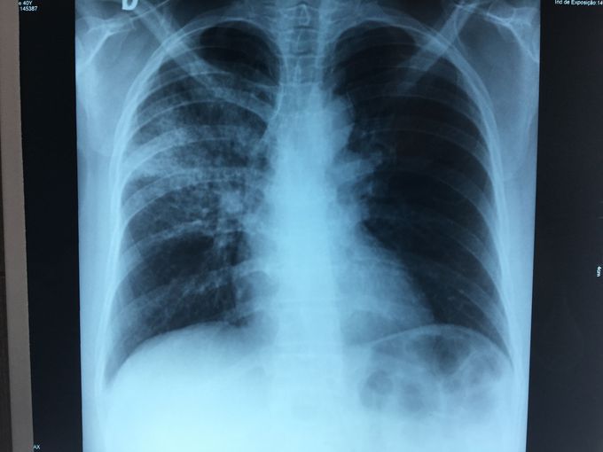 Tuberculous pneumonia