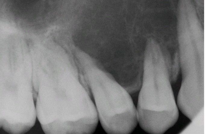 Mesenchymal Chondrosarcoma.