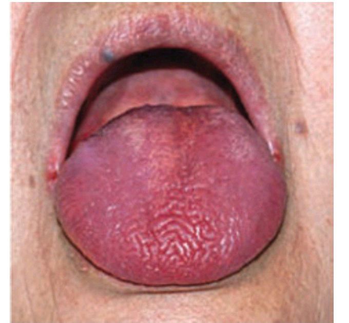 Dry mouth; candidosis