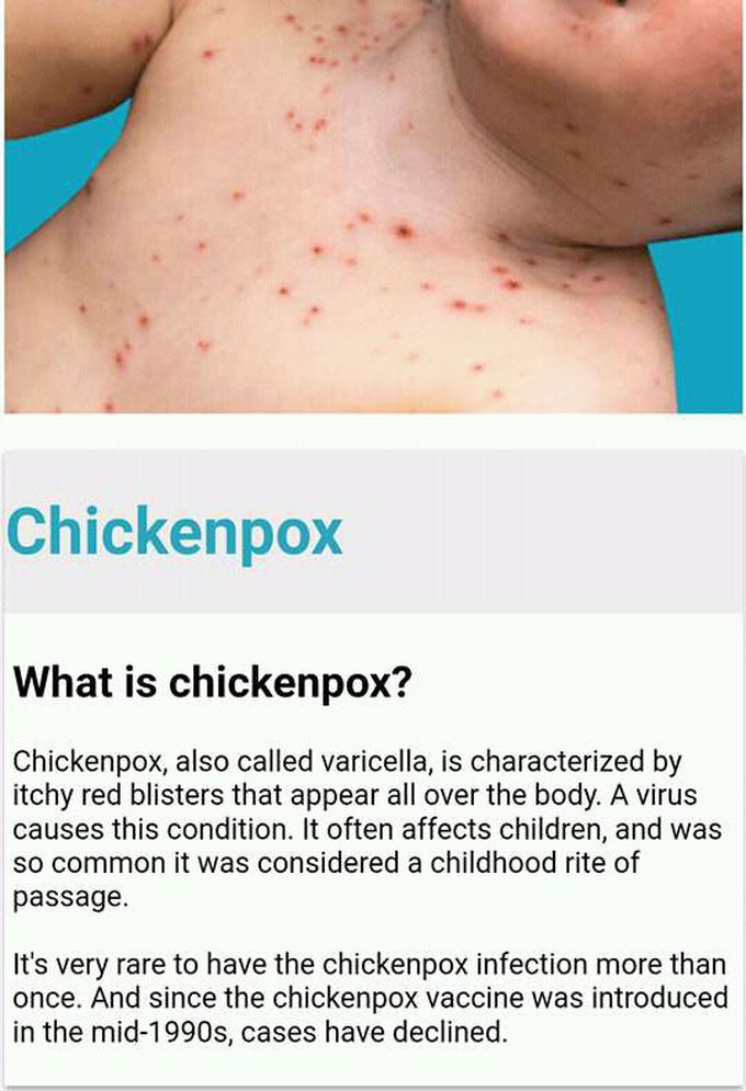 Chickenpox........👈