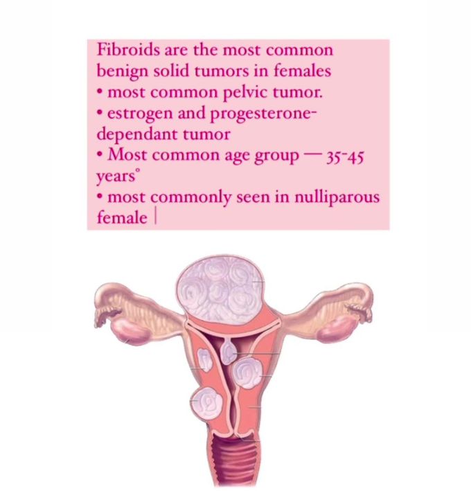 Fibroids