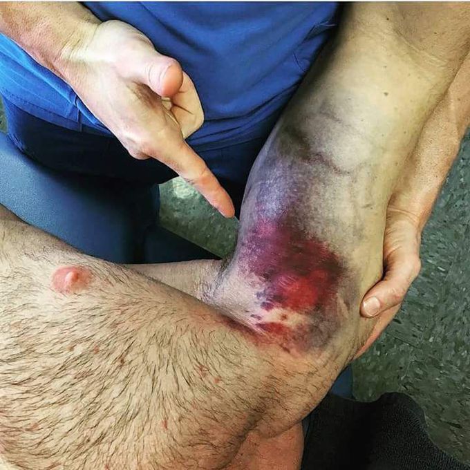 Muscle rupture