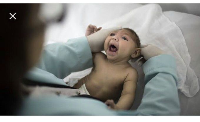 Microcephaly