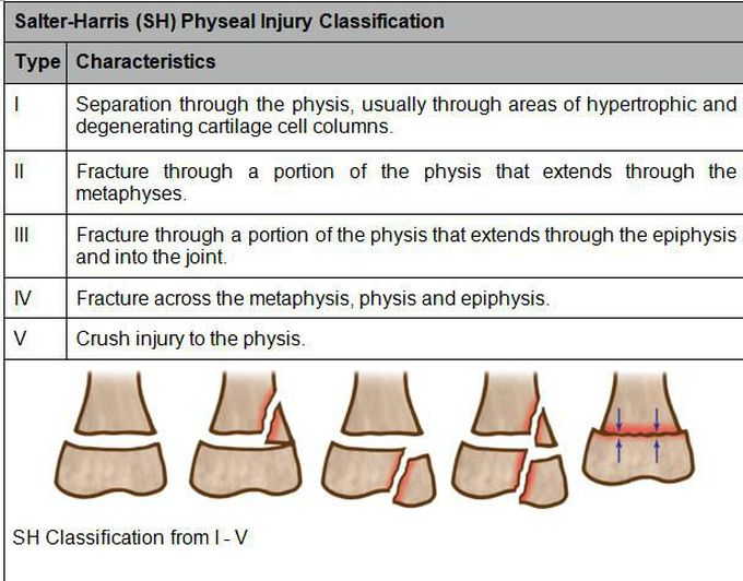 Salter Harris Classification of Fractures
