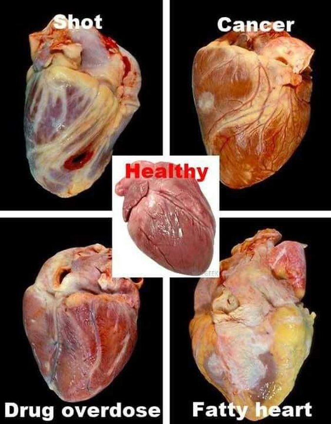 Various conditions of the human heart