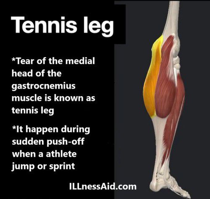 TENNIS LEG: CAUSES, SYMPTOMS, EXERCISES - ILLnessAid