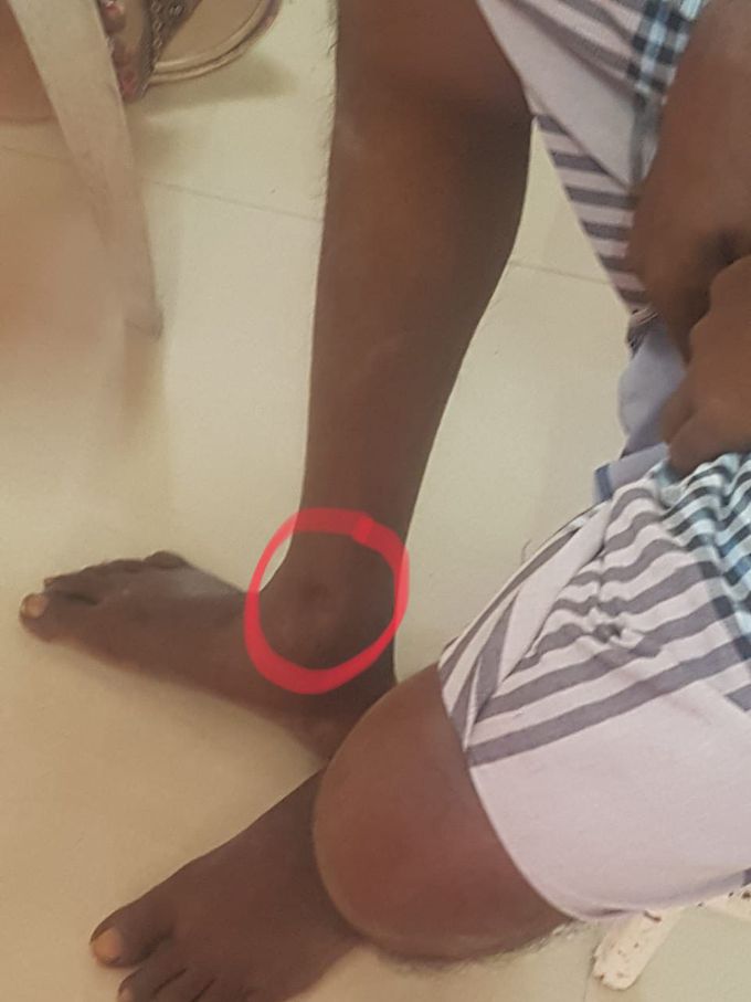 PEDAL EDEMA
