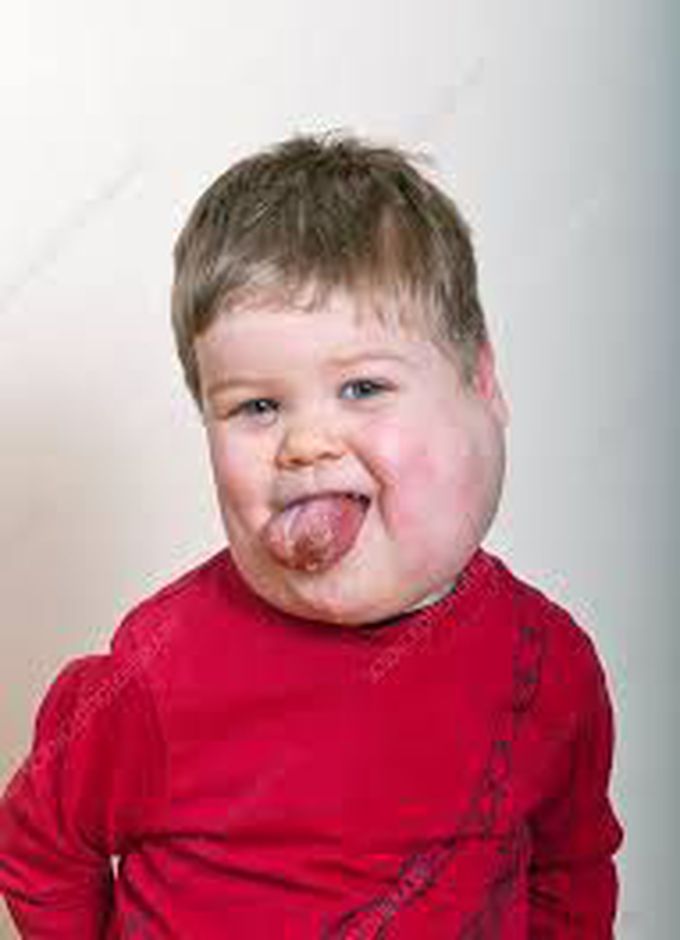 Symptoms of cystic hygroma