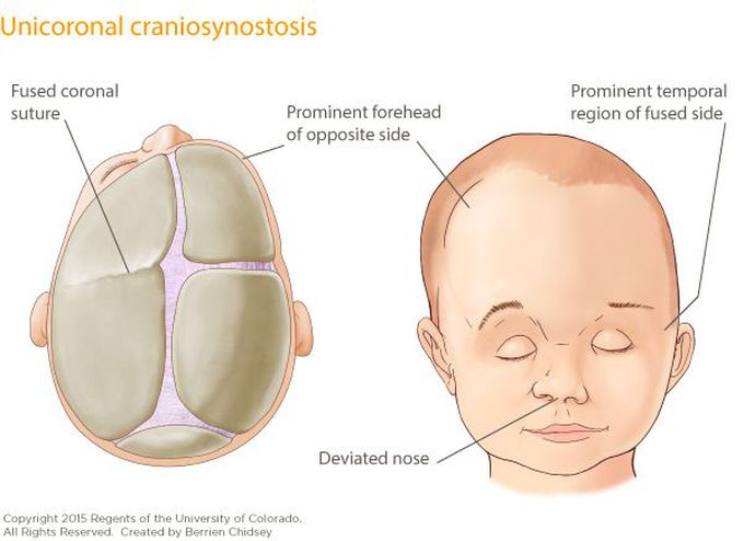 Craniosynostosis