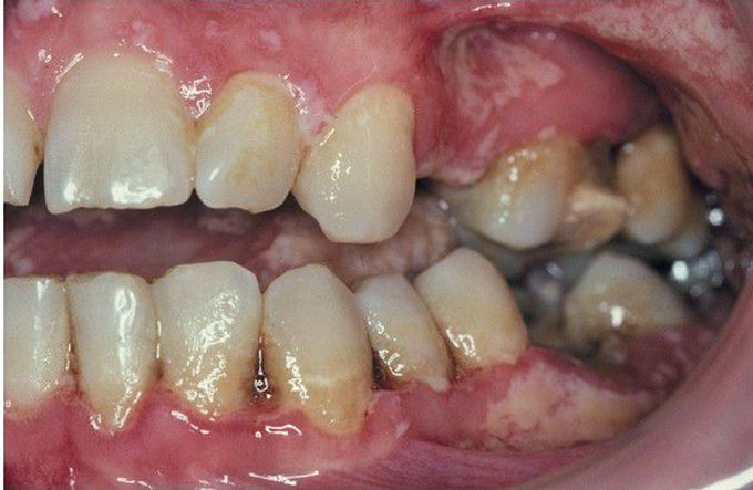 HIV-associated Necrotizing Ulcerative Gingivitis (NUG). 