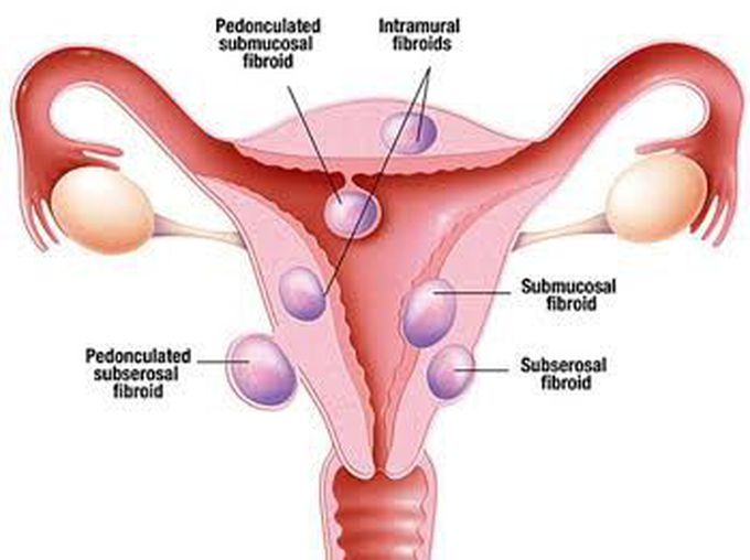 Types of fibroids