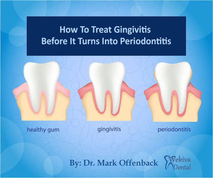 Gingivitis treatment