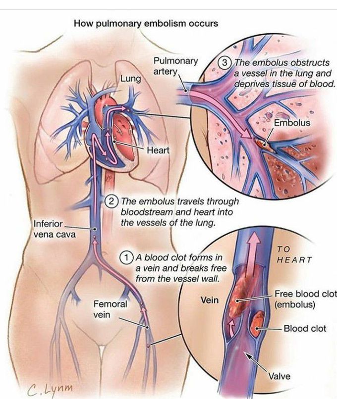Pulmonary embolism