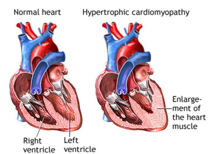 Hypertrophic cardiomyopathy