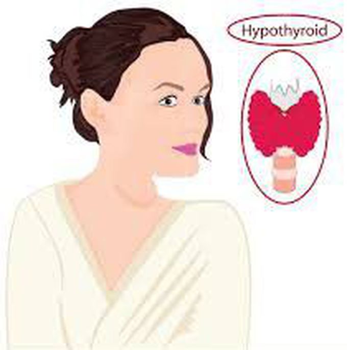 Treatment for goiter