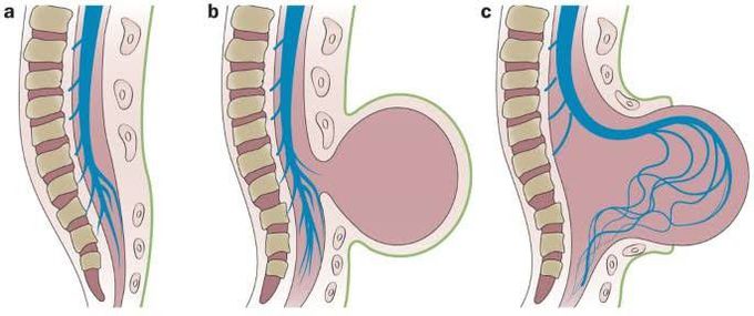 Spinal dysraphism