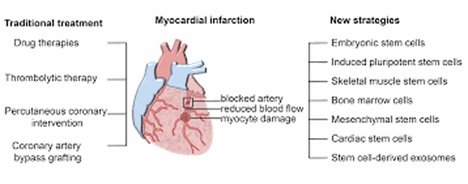 Treatment of myocardial infarction