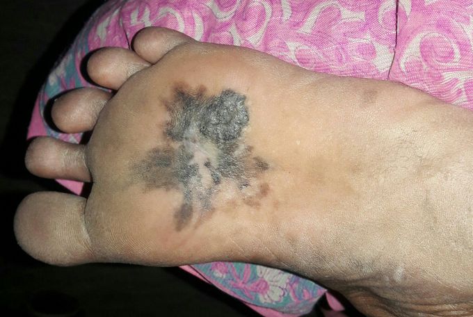 Melanoma