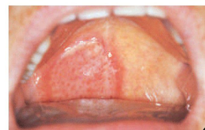 Localised oral purpura