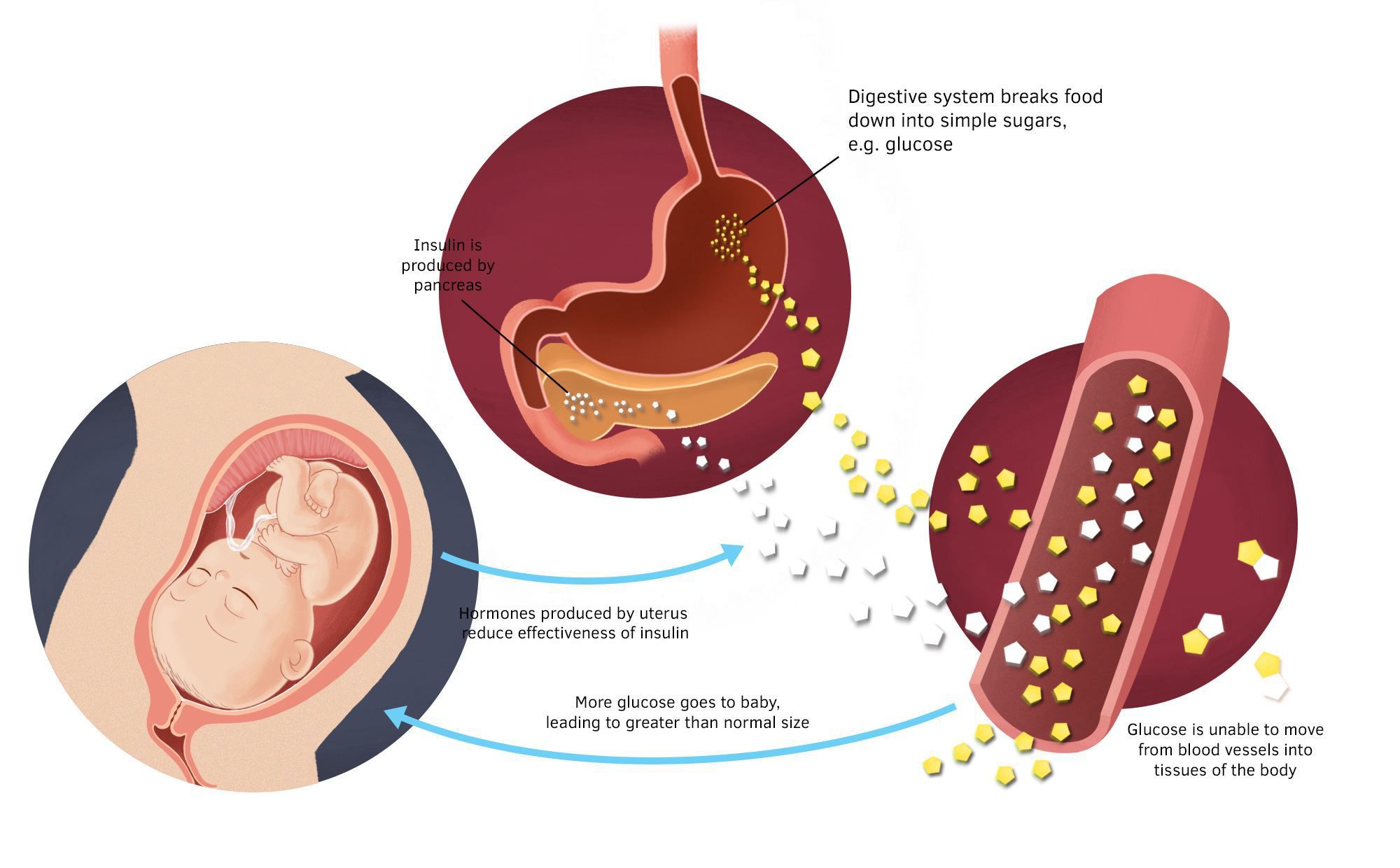 gestational diabetes diagram