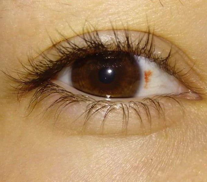 Subconjunctival hemorrhage
