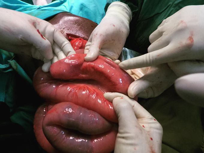 Incidental finding on a laparotomy 