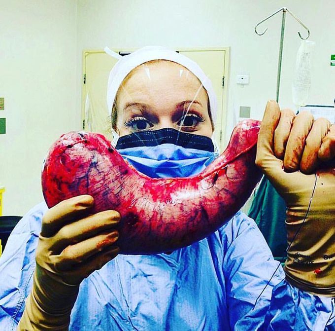 Sleeve gastrectomy