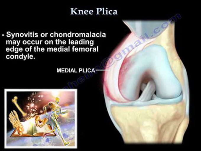 Knee Plica  and  Knee pain - Everything You Need To Know - Dr. Nabil Ebraheim