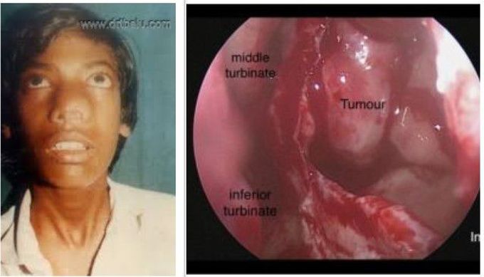 Juvenile Nasopharyngeal Angiofibroma: Symptoms, Staging, and Management