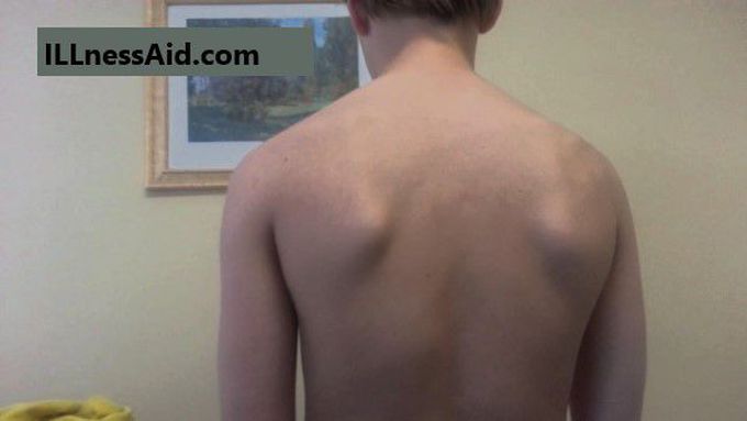 Scapular Dyskinesis: Causes, Treatment and More - ILLnessAid