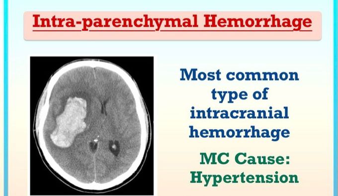 Intraparenchymal Hemorrhage