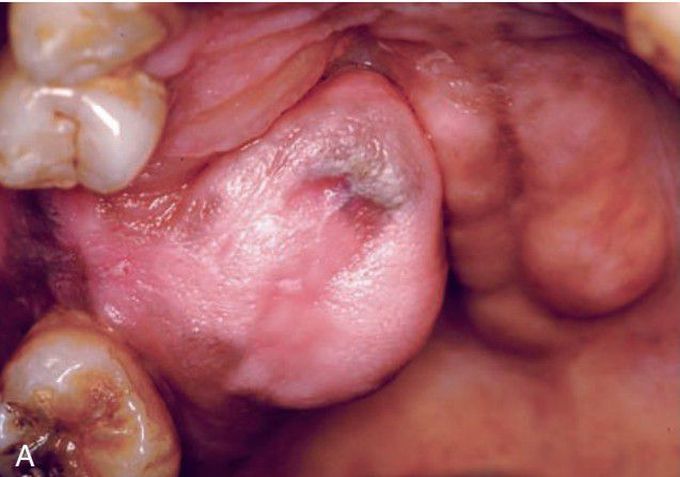 Ossifying fibroma