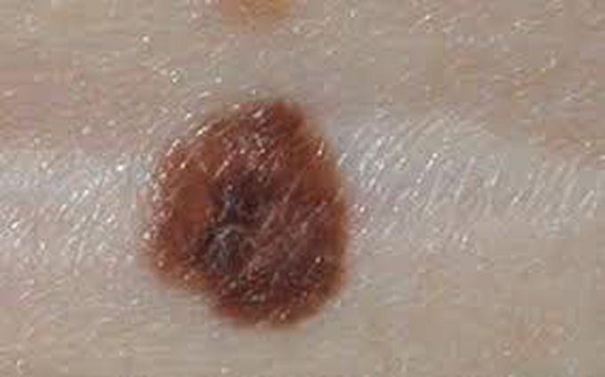 Melanoma