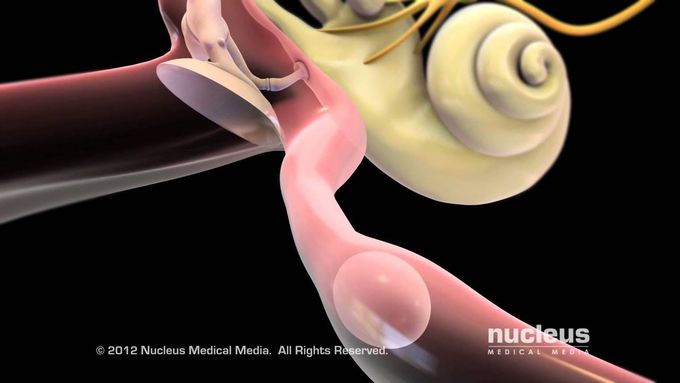 Myringotomy Procedure: Animated Explanation