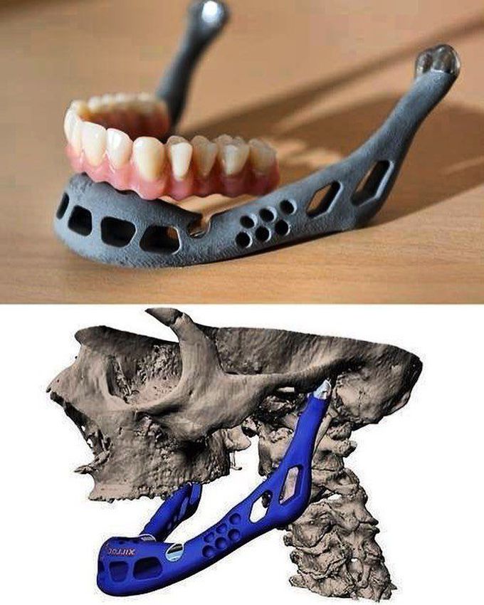 An incredible replacement mandible