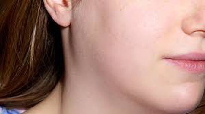 Treatment of mumps