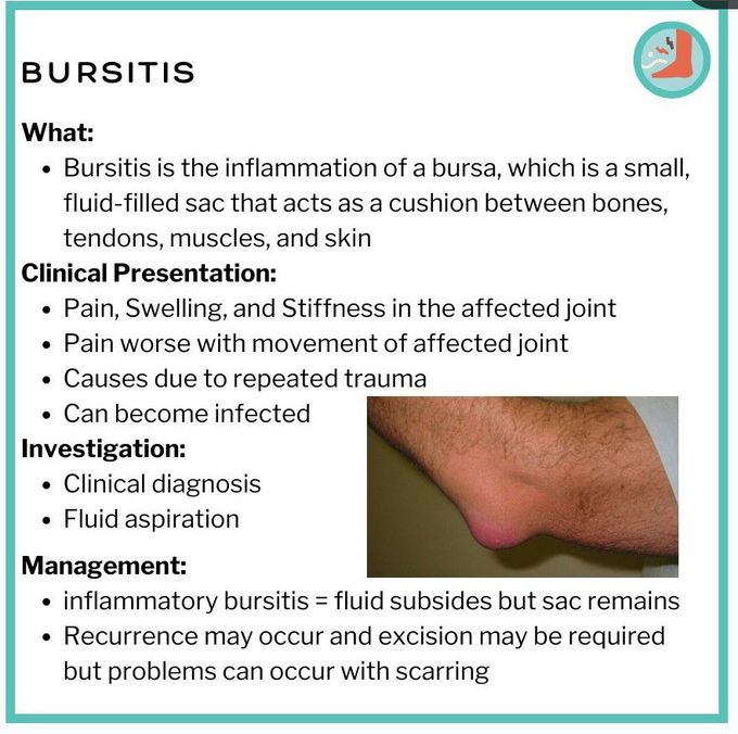 Bursitis