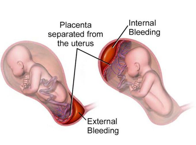 Placental Abruption