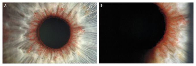 Neovascular Festoons on the Iris