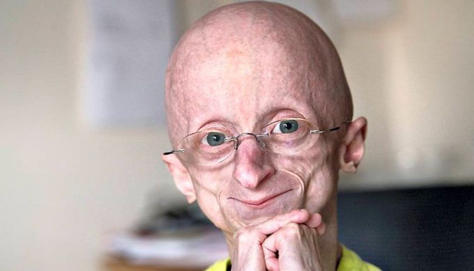 Hutchinson-Gilford Progeria Syndrome (HGPS) or Premature Aging
