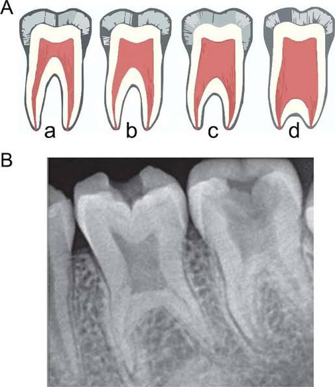 Taurodontism