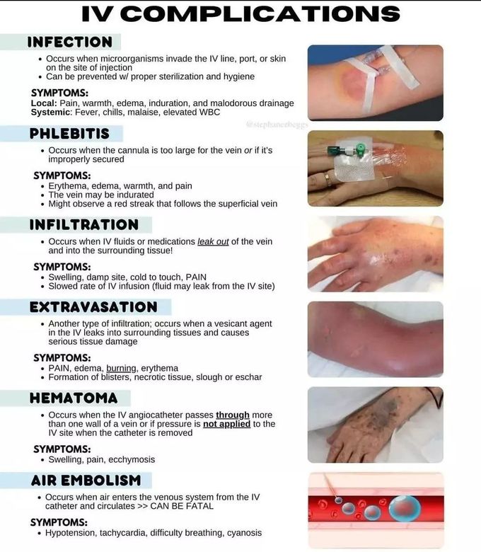 IV complications