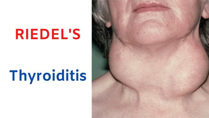 Riedel's Thyroiditis