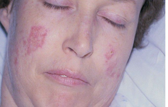 Systemic Lupus Erythematosus (SLE).