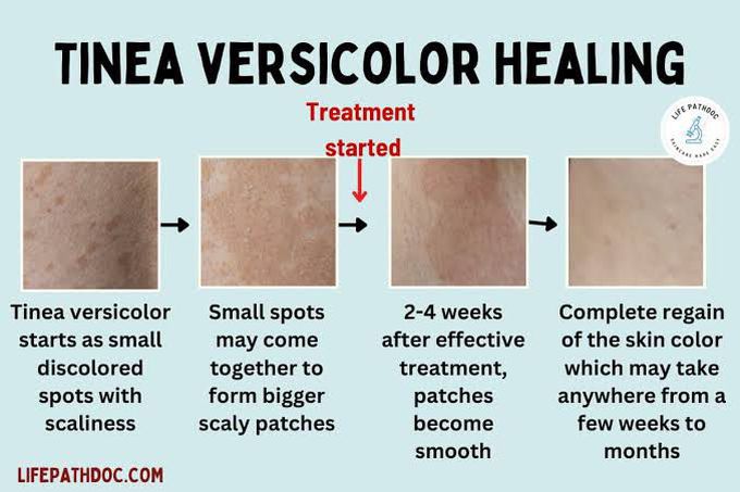 Tinea Versicolor Healing Stages